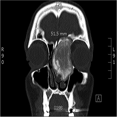 Coronal CT image of the sinuses showing a large mass obstructing the frontal sinus.