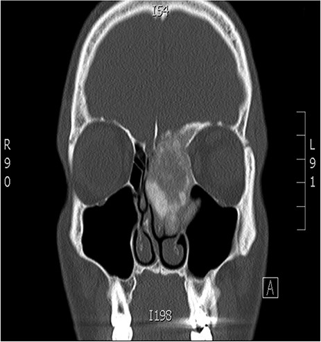 Coronal CT image of the sinuses showing a mass encroaching the orbit and skull base.