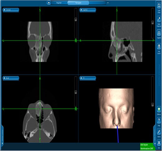 Image-guided endoscopic tumor removal from orbit and skull base.