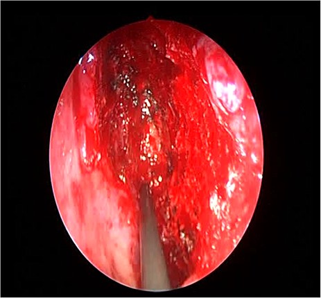 Endoscopic image showing the cavity after tumor removal from the orbit and skull base.