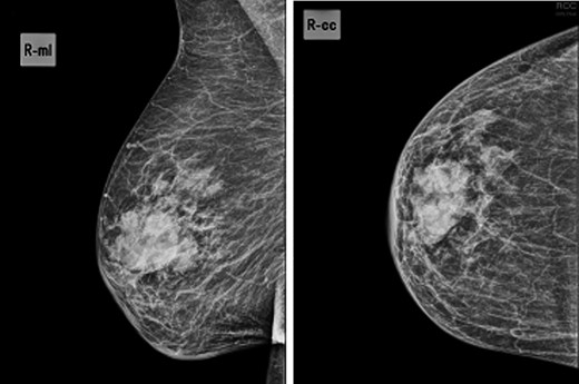 Mammogram—44.5 × 24.5-mm nodular lesion in the transition of the external quadrants of the right breast with lobulated contours and associated skin thickening.