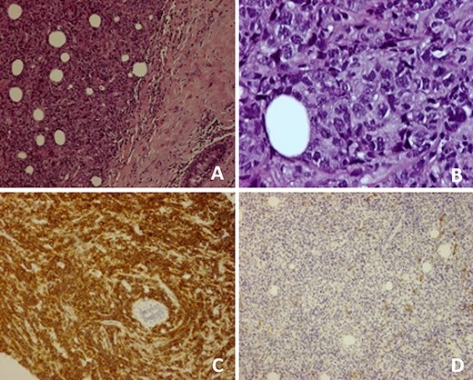 (A) Breast parenchyma with neoplastic infiltration by small- and medium-size lymphoid cells; (B) Cell composition of the neoplasm at higher magnification; (C) CD20 antibody immunostaining present in diffuse large B cell lymphomas; (D) No immunostaining of CD10 antibody, excluding follicular lymphoma.
