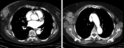 Staging CT Scan—lobulated mass associated with exuberant ipsilateral axillary adenomegalies.