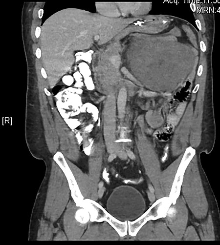 Immunohistochemical staining of the tumor cells showed positive nuclear staining for beta-catinine (A) and negative staining for CD117, DOG-1, SMA, CD34, and S100 (B) consistent with a desmoid tumor.