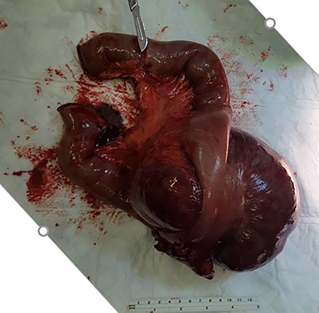 A computed tomography (CT) scan showed a well-defined, inhomogeneous mass at the left hypochondrium displacing the stomach, colon, and nearby organs.