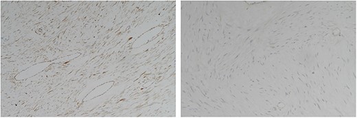 Gross appearance of the resected mass arising from the jejunal wall.