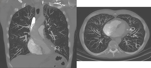 CT scan showing migrated coil.