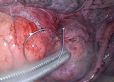 Thoracoscopic image of coil on retrieval.