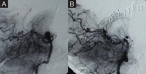 Preoperative DSA showing a complex basilar tip aneurysm (A). Complete occlusion of the aneurysm in the postoperative DSA (B).