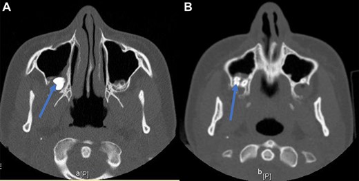 (A, B) CT sinus images of a displaced third molar (arrow) into the posterior aspect of the maxillary right sinus.