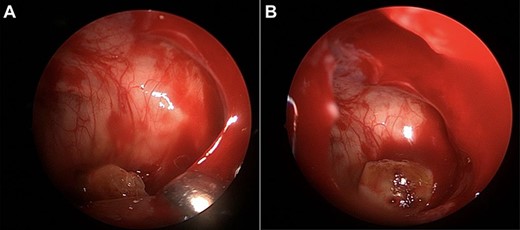 (A, B) intraoperative images of the third molar removal from the maxillary sinus.