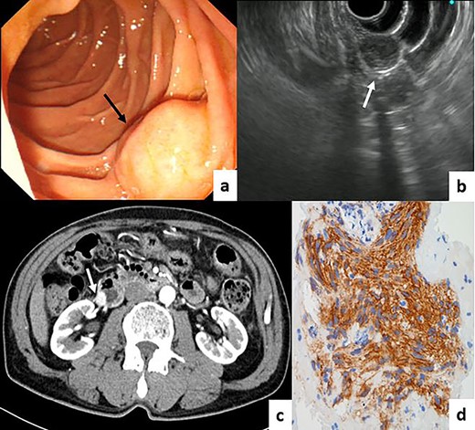 (a) EGD showed a submucosal-like mass on the opposite side of the duodenal papilla (black arrow). (b) EUS revealed a tumor derived from the muscular layer of the duodenal wall (white arrow). (c) CT showing an enhanced tumor in the descending part of the duodenum. (d) Immunohistochemical assessment of the fine needle aspiration biopsy samples showing the GIST (KIT ×400).