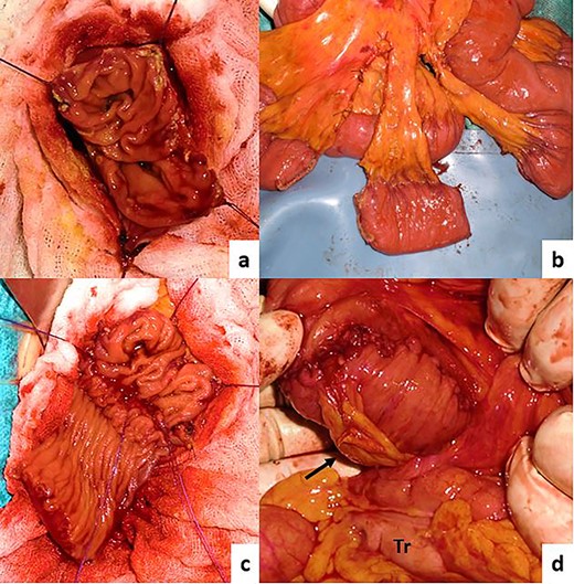 Intraoperative images. (a) Partial duodenectomy, (b) pedicled jejunal flap formation, (c) anastomosis, (d) finished reconstruction. The jejunal flap was passed through the retro-colic route (jejunal pedicle: black arrow, transverse colon: Tr).