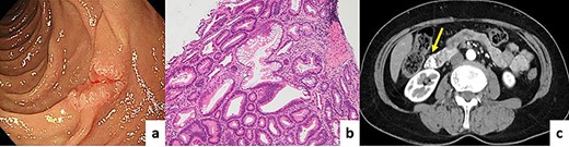 (a) EGD showing a 0–IIc type tumor on the opposite side of the duodenal papilla. (b) Pathological diagnosis was well-differentiated adenocarcinoma (hematoxylin and eosin ×40). (c) CT revealed some clips taken after tumor biopsy as a hyperdense area.