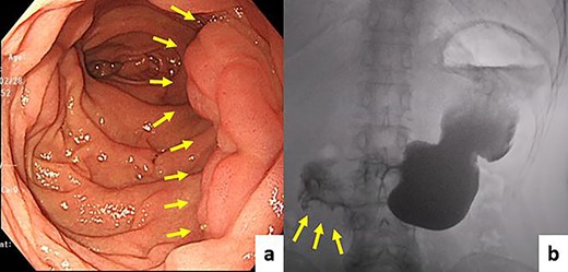 Follow-up EGD and upper gastrointestinal radiography did not show stenosis, diverticulum, or motility disorder. (a) EGD, (b) upper gastrointestinal radiography.