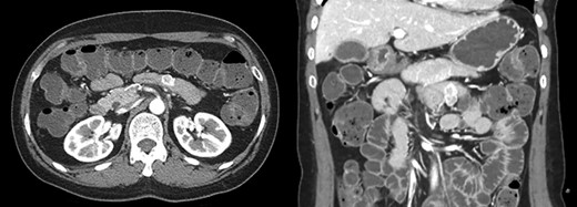 Abdomen CT showed a 2.3 cm sized well-defined heterogenous enhancing mass in the proximal jejunum and GIST was strongly suspected.