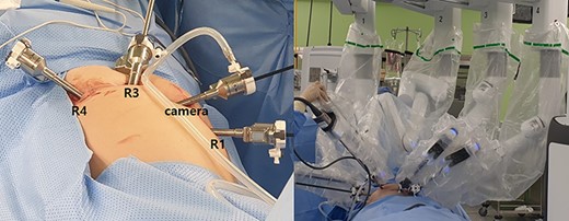 Trocars position with da Vinci Xi system.