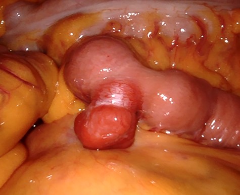 GIST in the jejunum as exophytic lesion.