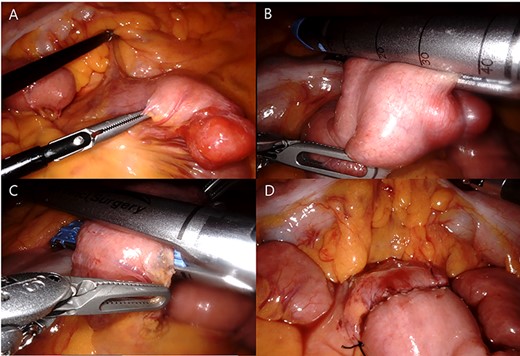 Robotic jejunal resection and anastomosis: identification (A), distal transaction (B), proximal transaction (C) and after anastomosis (D).