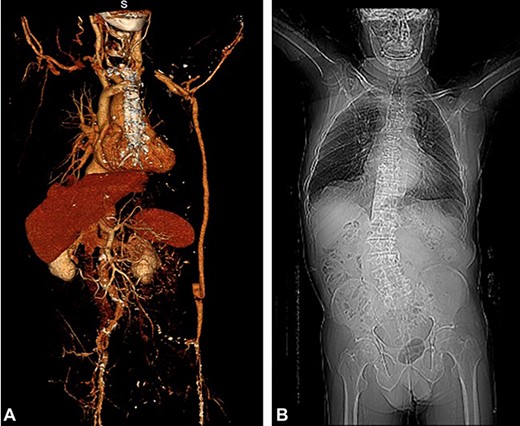 (A) Kinking of the prosthesis (CT scan), (B) serious scoliosis