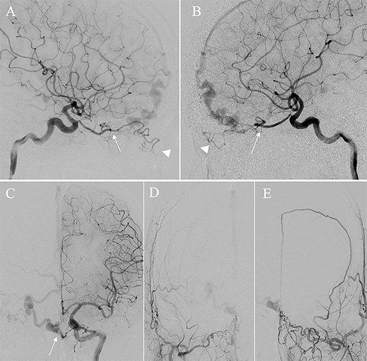Right (A) and left (B and C) internal carotid artery angiography before initial treatment showing ACF–dAVF with feeding arteries arising from branches of the OphAs; ethmoid artery (arrow) and dorsal nasal artery (arrowhead) (D and E). Bilateral external carotid artery angiography before initial treatment, anteroposterior view, showing the ACF–dAVF fed by bilateral distal internal maxillary arteries and the left middle meningeal artery.