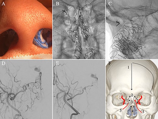 (A) Inserting gauze infiltrated with epinephrine into bilateral nasal cavities. (B and C) Radiograph showing the gauze inserted toward the upper nasal cavity. (D) DSA before inserting the gauze, anteroposterior view, showing blood flow from the right distal IMA. (E) DSA immediately after inserting the surgical gauze, anteroposterior view, showing decreased blood flow from the IMA. (F) Schematic drawing of remaining (red solid line) and occluded feeding arteries (black dotted line) after inserting the surgical gauze. Schema describing that the left dorsal nasal artery (asterisk) remained patent after embolizing the left middle meningeal artery (1), bilateral ethmoid arteries (2) and the right dorsal nasal artery (3), and blood flow from bilateral distal IMAs (4) decreased using our transnasal flow reduction method. (5) Angular artery.