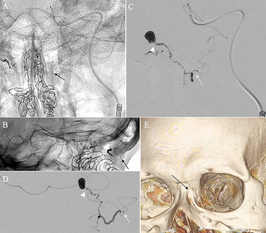 Angiographic images, anteroposterior (A) and lateral (B) views, showing the microcatheter (arrow) navigated into the terminal branch of the left terminal branch of the ophthalmic artery, which connects to the dorsal nasal artery. Digital subtraction angiography, anteroposterior (C) and lateral (D) views, showing NBCA injected via the microcatheter (arrow) penetrating into the shunt point (arrowhead) without reflux of the NBCA. (E) Three-dimensional reconstruction of the skull showing the NBCA cast (arrow), which was embolized via the dorsal nasal artery.