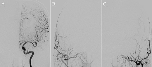 (A) DSA, anteroposterior view, showing complete obliteration of the anterior cranial fossa–dural arteriovenous fistula. (B and C) DSA, anteroposterior view, showing restored blood flow from the internal maxillary artery branches.