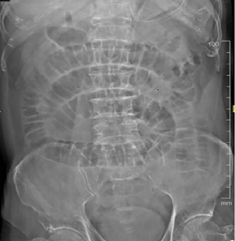 Dilated small bowel with collapsed large bowel.