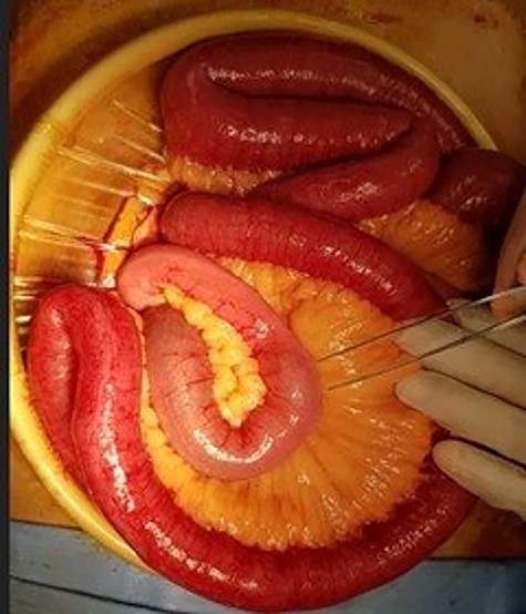 Intraluminal mass found in distal ileum.