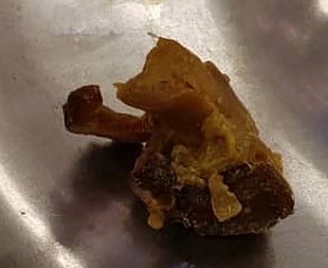 Partially cut shiitake mushroom retrieved at enterotomy.