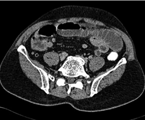 CT scan showing a suspicious mass at the distal ileum of the second patient.
