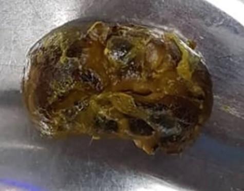 An uncut whole piece of shiitake mushroom retrieved in the second patient.