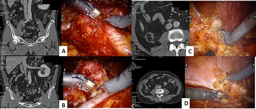 CT scan and intraoperative image of the: iliac bifurcation lymph node recurrence (A), the interaortocaval space lymph node recurrence (B), the renal fossa recurrence (C) and the peritoneal recurrence (D)