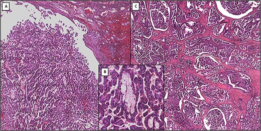 (A) Low-power photomicrograph showing primary papillary renal cell carcinoma (original magnification ×4). (B) Medium-power photomicrograph showing the detailed structure of primary papillary renal cell carcinoma: papillae formed by delicate fibrovascular cores that contain foamy macrophages (original magnification ×20). (C) Low-power photomicrograph showing metastatic papillary renal cell carcinoma (original magnification ×4)