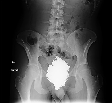 Erect abdominal X-rays (frontal view): presence of many radiopaque foreign bodies in the pelvis