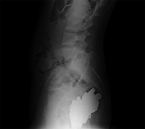 Erect abdominal X-rays (lateral view): confirmation of the presence of many radiopaque foreign bodies in the pelvis
