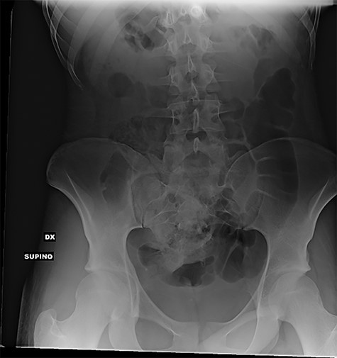 Supine abdominal X-rays (frontal view): absence of pelvic radiopaque foreign bodies at the end of the procedure