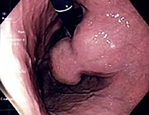 Endoscopic image of stomach GIST.