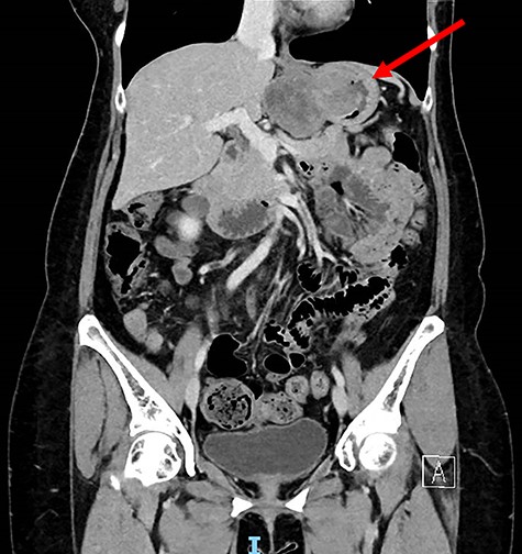 Coronal computed tomography image of stomach GIST.