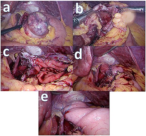 Intraoperative picture series: (a) tumour prior to resection; (b) partially resected tumour with gastrotomy made; (c) post tumour resection with oesophagotomy and gastrotomy made; (d) post oesophago-gastroplasty; (e) anterior fundoplication.