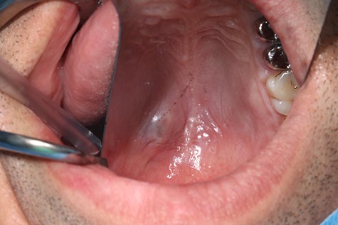 Clinical appearance of the tumor in the transition from hard to the soft palate on the left side of the mouth