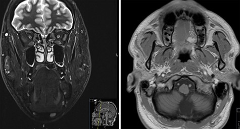 MRI scans of steatocystoma simplex involving the left side of the palate