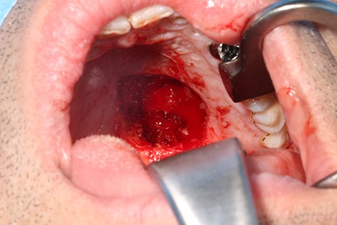 Clinical picture after resection of the tumor