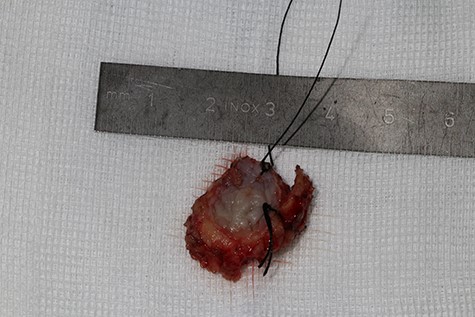 Specimen after excision for histopathological evaluation
