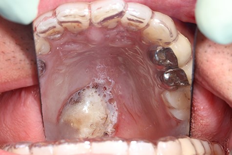 Primary wound care with hemostyptics and an acrylic splint