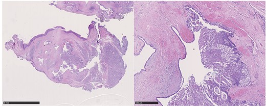 Hematoxylin–eosin staining: glandular tissue covered with squamous epithelium with manifestations of a cystic, regressively changed epithelial lesion