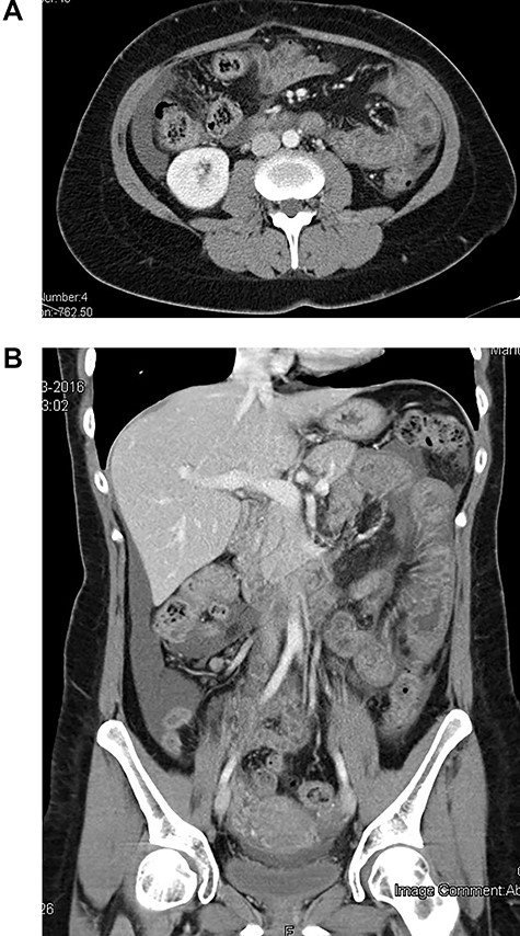 CT scan at initial clinical presentation (A—coronal plane; B—axial plane)—moderated distended small bowel loop with diffuse circumferential wall thickening, submucosa edema (‘target sign’) and shaggy luminal contour. Moderate amount of ascites in peritoneal cavity is also noted.
