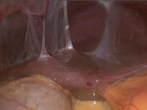 Colonoscopy revealed several adhesions throughout the pelvic organs.