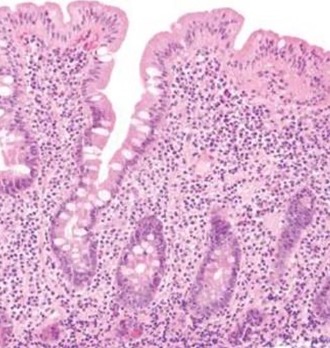 Biopsy revealed blunting of villi with subsequent crypt hyperplasia with no crypt abscesses, fistulas or granulomas.